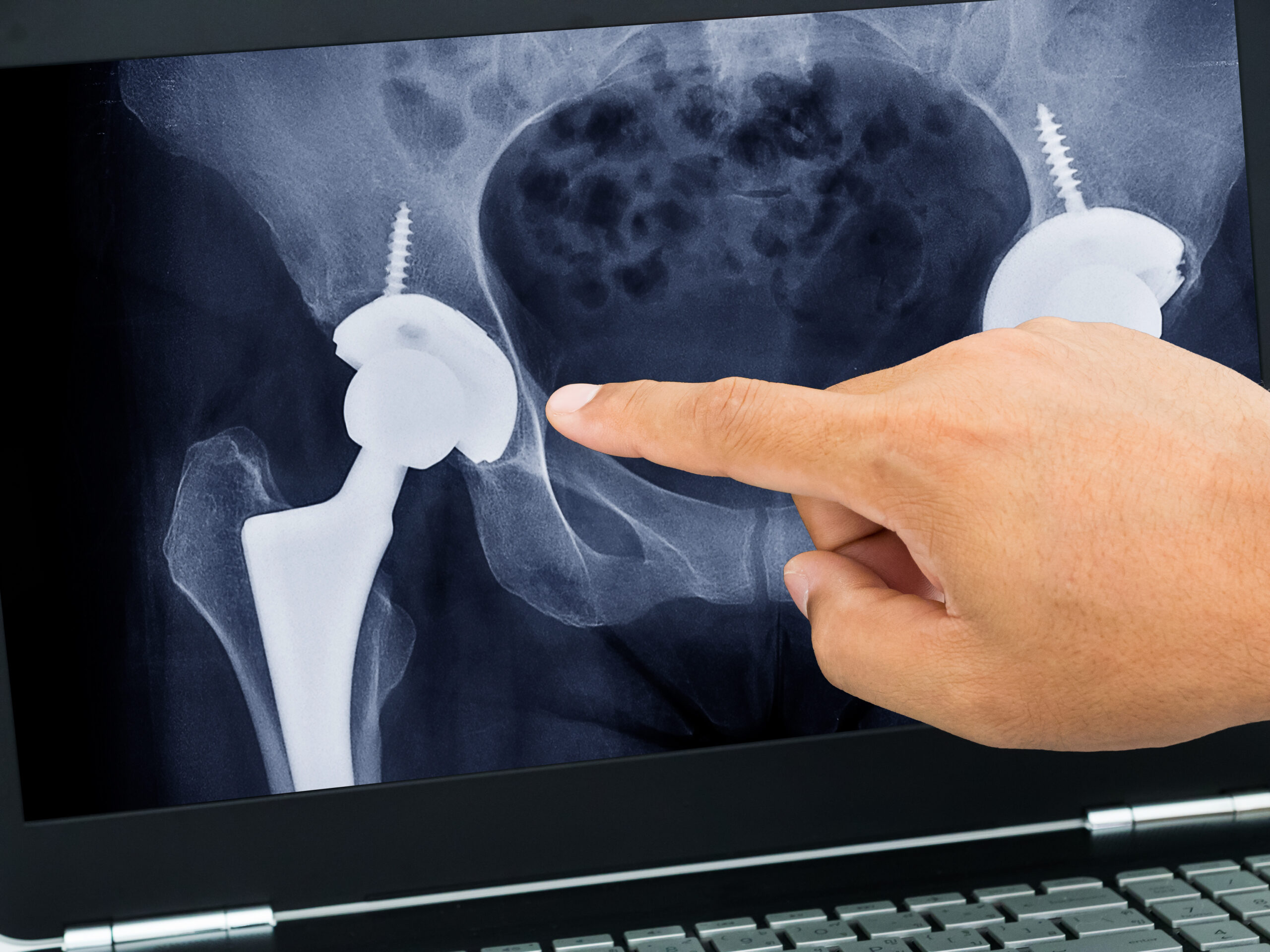 Total Hip Replacement Arthroplasty (THA)